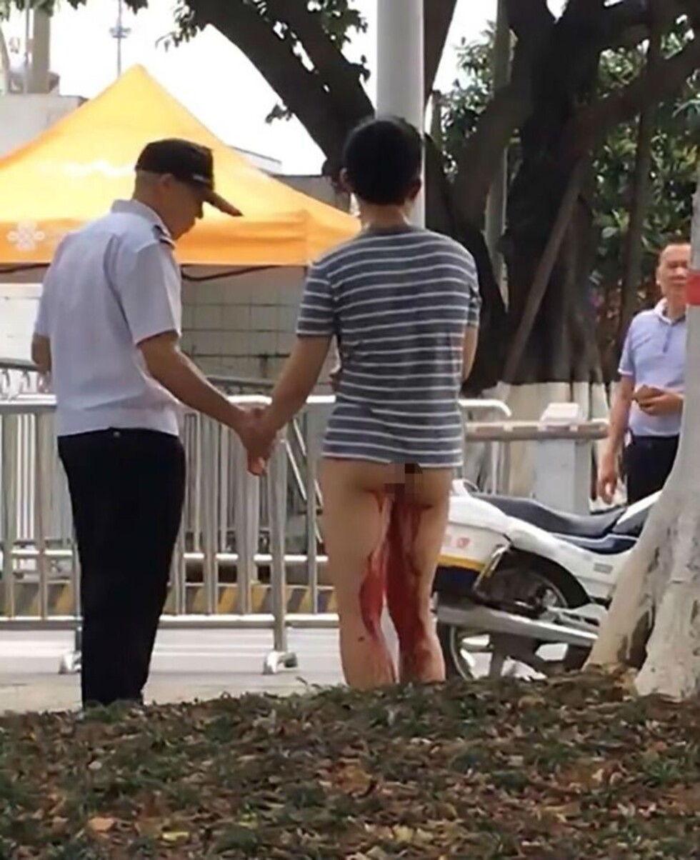 Le dijeron que tenía el pene chico y se lo cortó