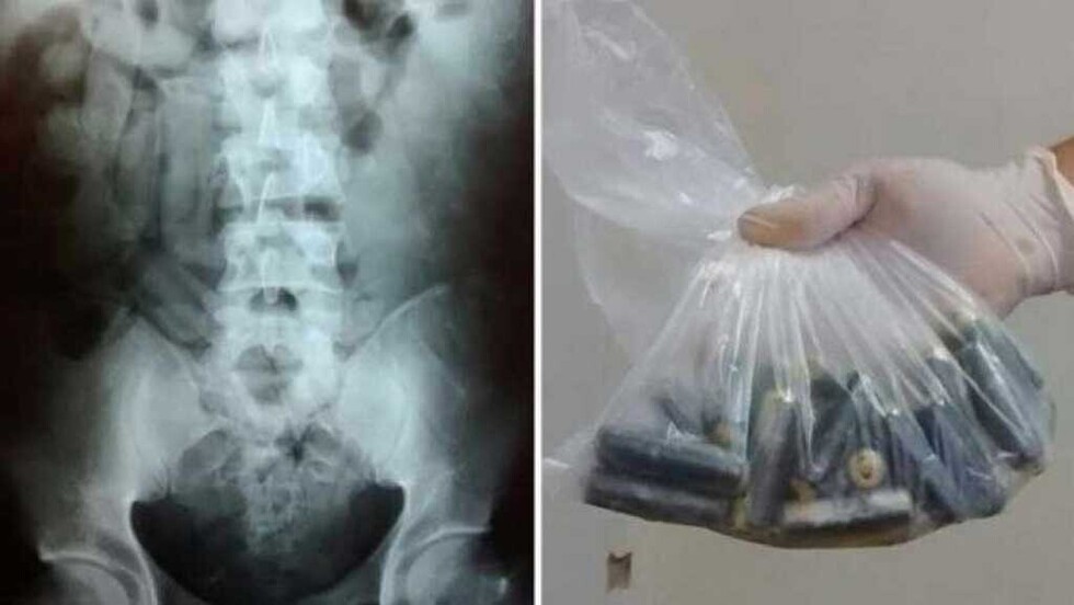 Extraen a una persona 25cápsulas de cocaína que había ingerido