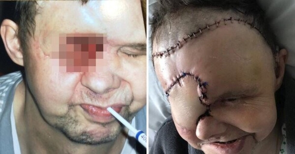 Mal diagnóstico lo dejó con 1 agujero en la cara