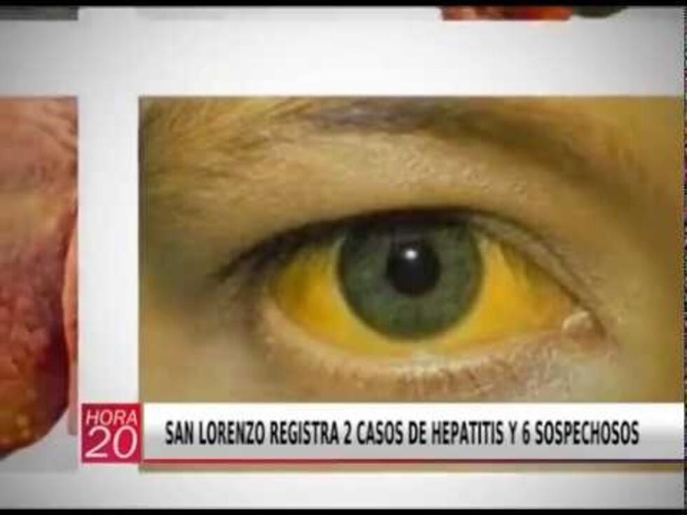 San Lorenzo registra 2 casos confirmados de hepatitis y 6 sospechosos