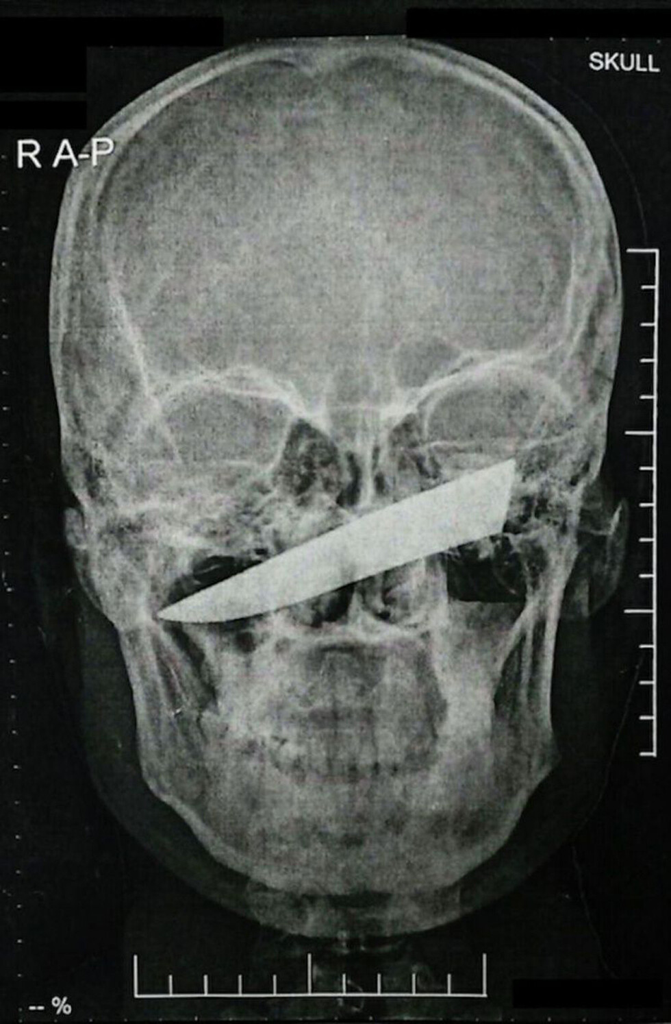Capricho: pasó 1 día con un cuchillo en la cara