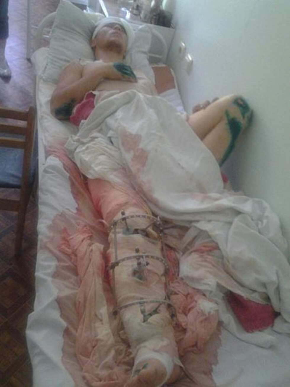Lo balean por robarle y le amputan la pierna