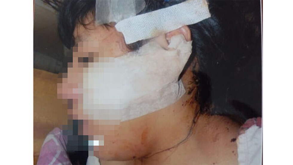 Mujer recibió 50 puntos  de sutura  en el rostro