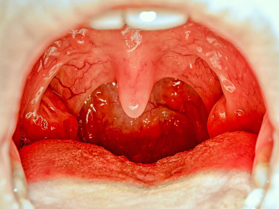 ¿Qué es la   uvulitis?