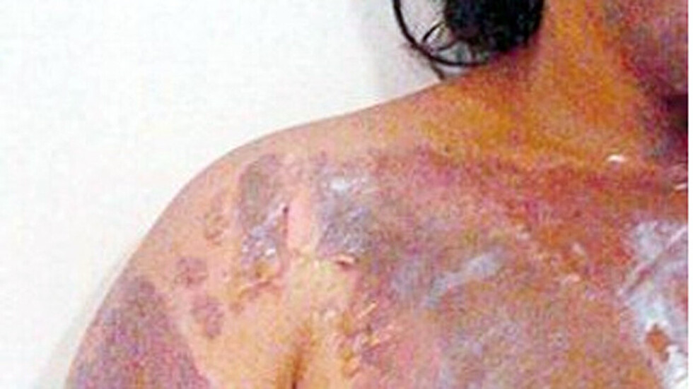 Imputan a hombre por prender fuego a su pareja