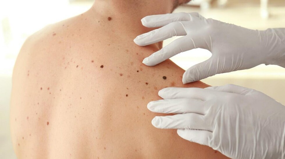 Los lunares peligrosos y el cáncer, tips para detectarlos