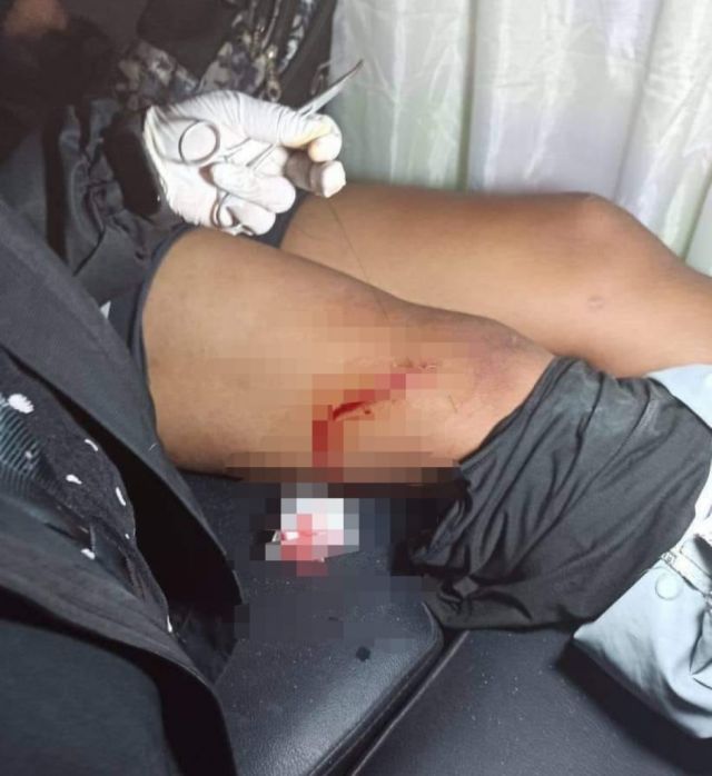 Personal de aseo en Tarija sufre un accidente por inadecuado manejo de residuos 