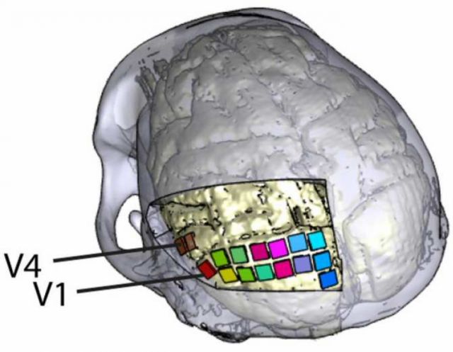 Un nuevo implante cerebral con electrodos podría ayudar a personas ciegas a percibir formas y letras