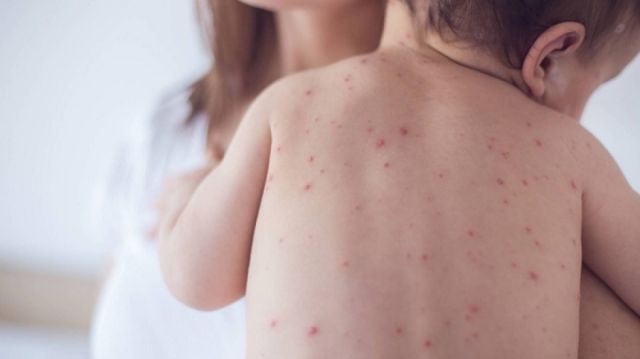Se reactiva la vacunación contra el polio, sarampión y VPH en Tarija