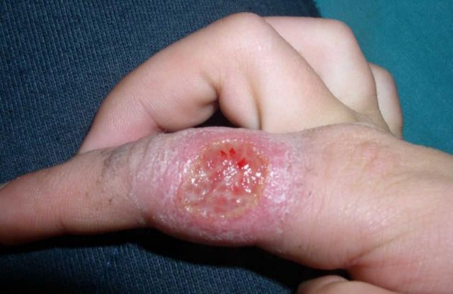 Bermejo registra dos  nuevos casos de leishmaniasis