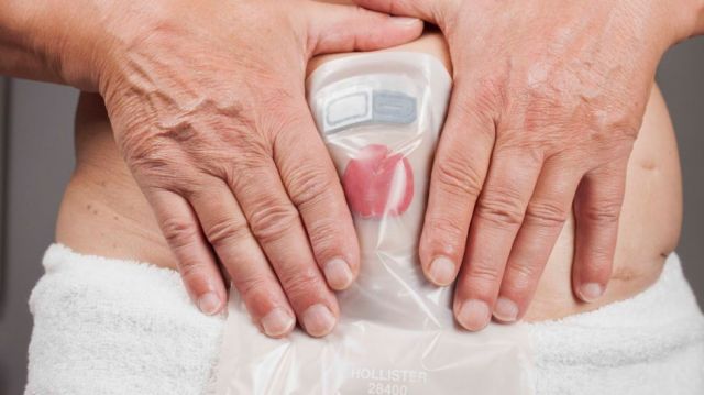 Ser un paciente  ostomizado y sus cuatro retos 