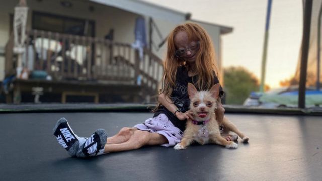 Muere a los 15 años Adalia Rose, la estrella de Internet que inspiró la película “El curioso caso de Benjamin Button”