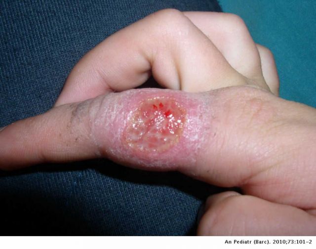 Villa Montes alerta por los casos de leishmaniasis