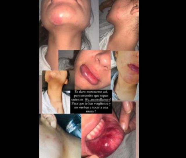 Joven tarijeña fue víctima de violencia por su novio, FELCV no quiso recepcionar la denuncia