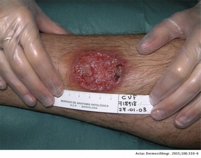 Alarma en Villa Montes por siete casos de leishmaniasis