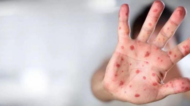 Reportan primer caso sospechoso de viruela del mono en Santa Cruz-Bolivia 