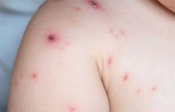 Santa Cruz reporta segundo caso sospechoso de la viruela del mono