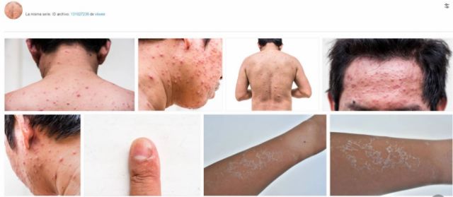¡No lo creas! Estas imágenes no registran la viruela del mono