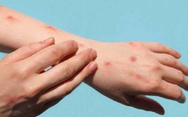 Descartan viruela del mono en paciente sospechoso de Cochabamba