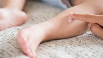 En Santa Cruz, aíslan a menor por sospecha de viruela del mono 