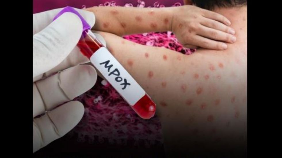 Sedes de La Paz activa vigilancia epidemiológica por la viruela símica