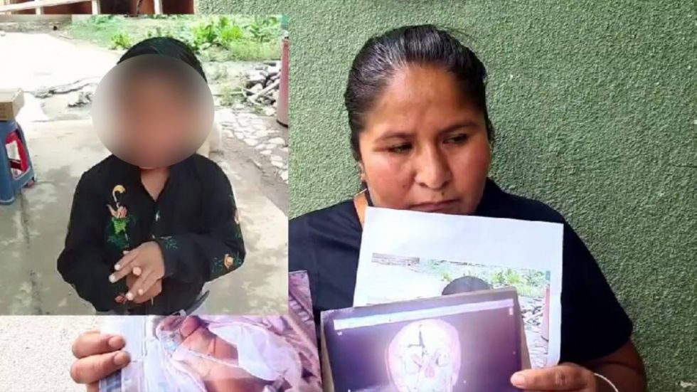 Tarija: Menor cae de una terraza y sufre varias fracturas en la cabeza