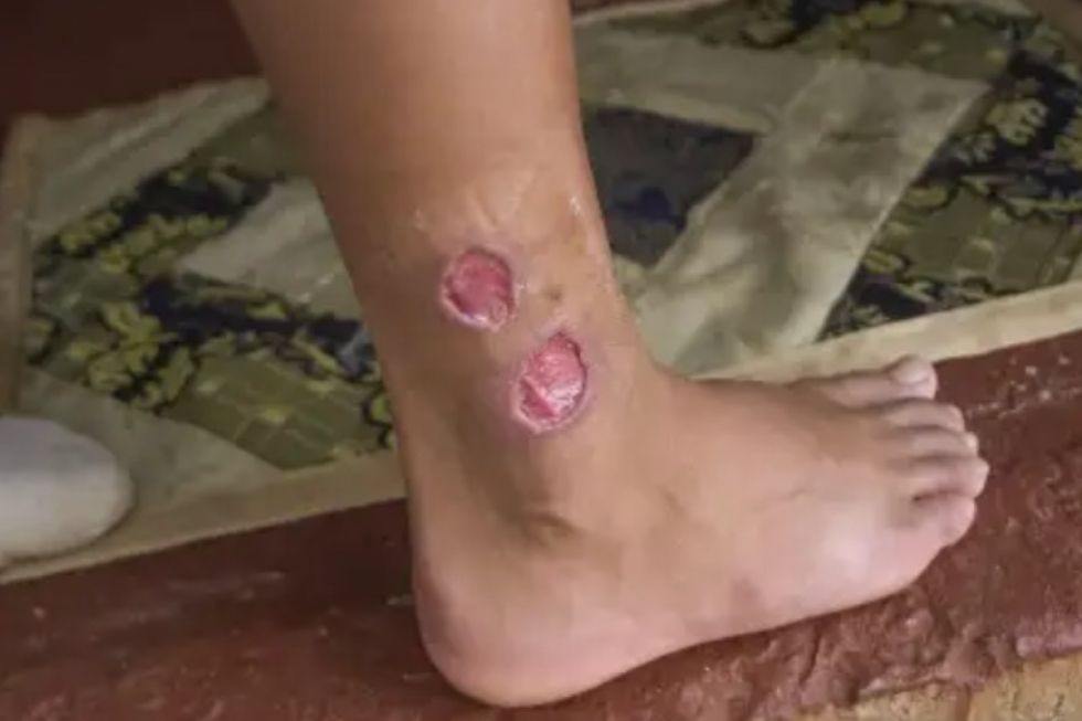 Confirman caso de leishmaniasis visceral en Villa Montes