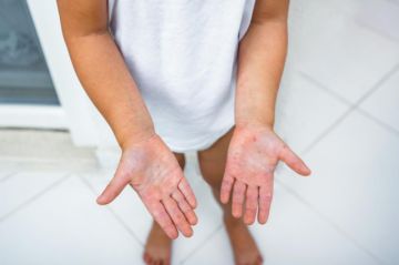 Hay un caso sospechoso de sarampión en Caraparí 