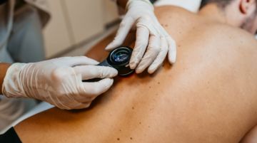 Detectan preocupante incremento de cáncer de piel tras estudio a más de 500 pacientes
