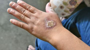 Salud reporta 12 casos de leishmaniasis y activa medidas preventivas en zonas de riesgo