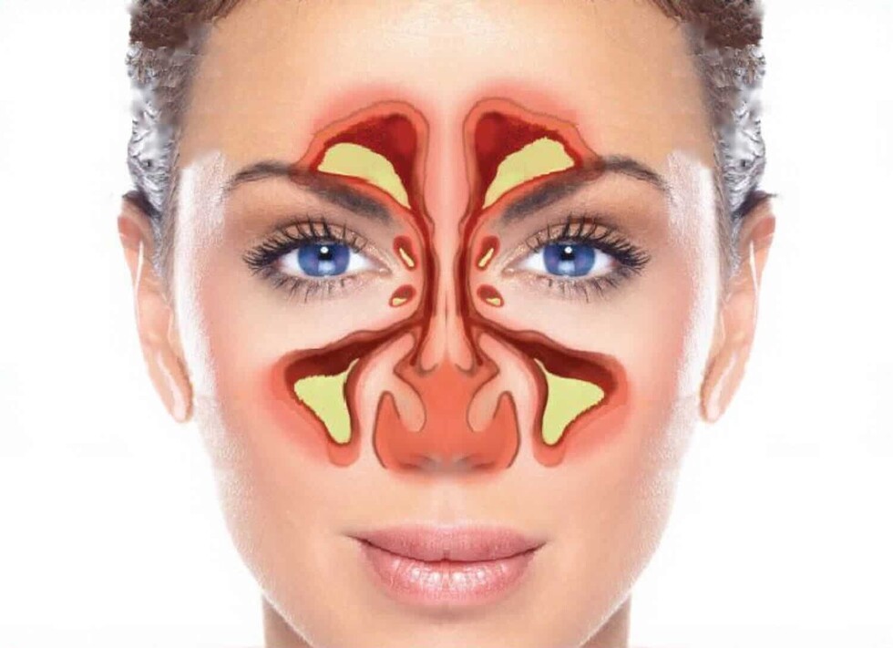 ¿Cómo diagnosticar   la sinusitis?