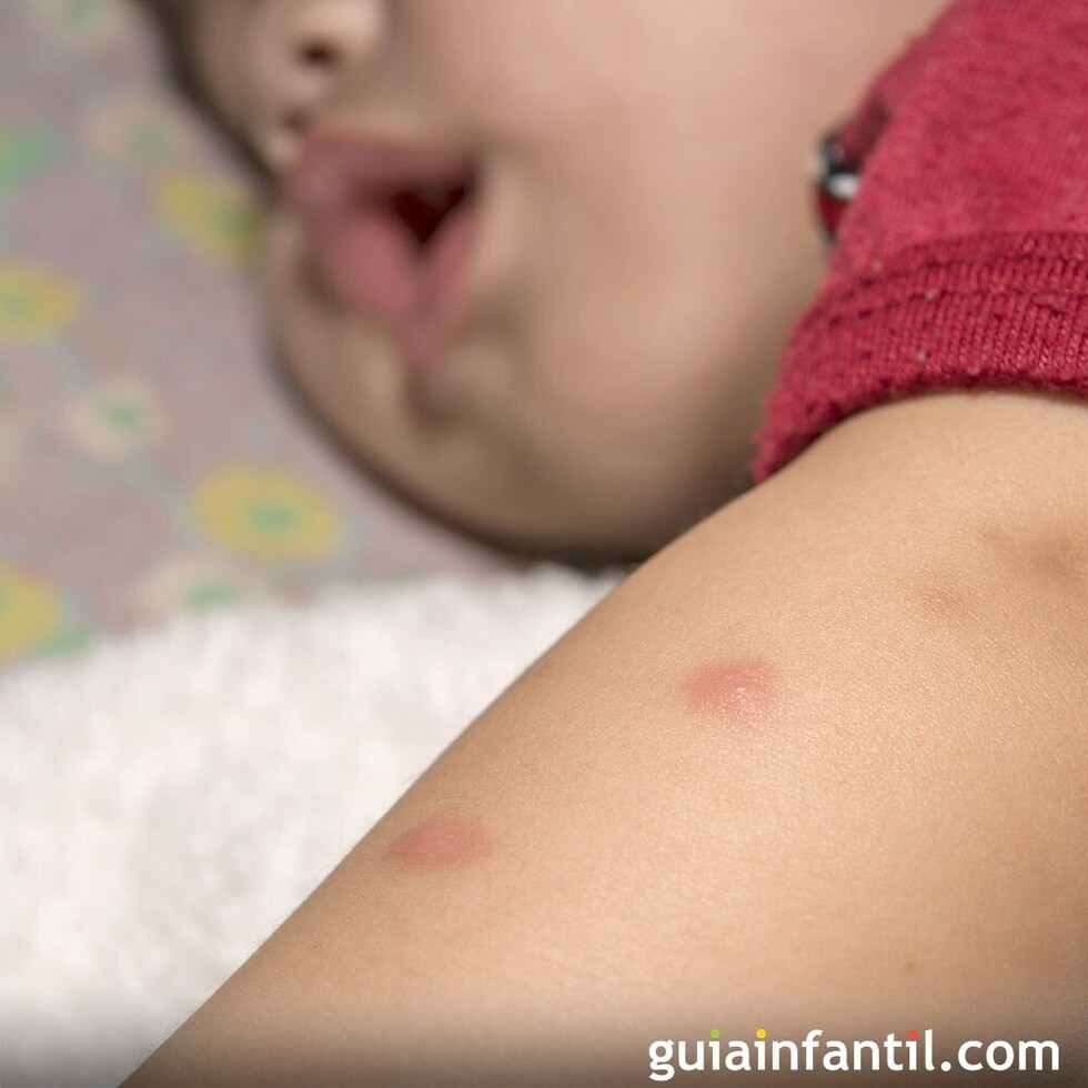 Picaduras de mosquito  en bebes