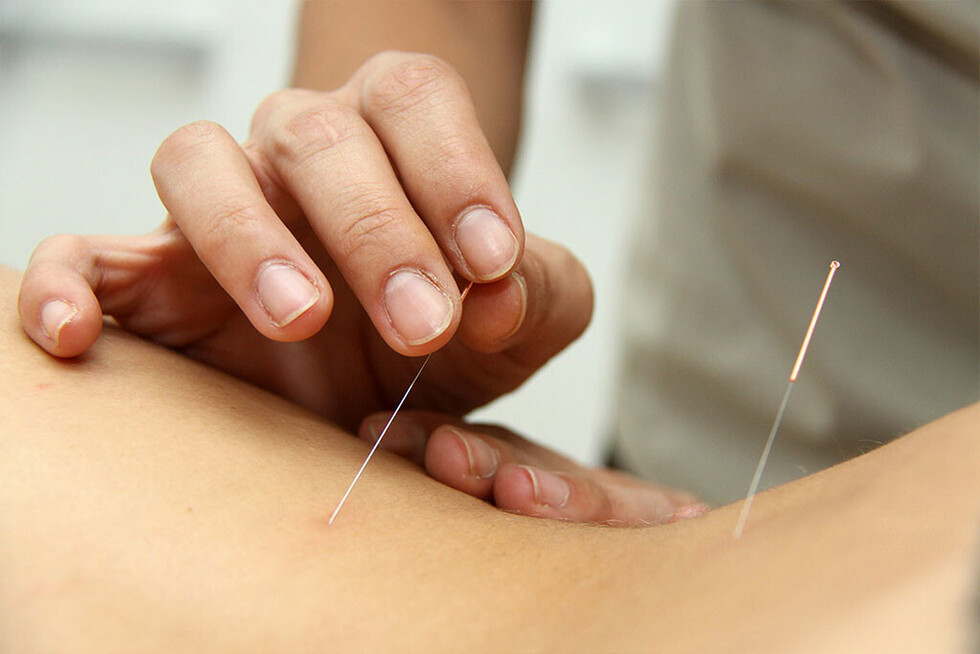 Beneficios de la acupuntura