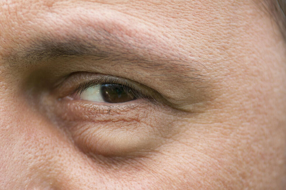 Significado  de los ojos   hinchados