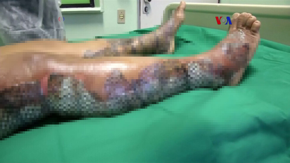Amputarán piernas a hombre que se quemó con mechero