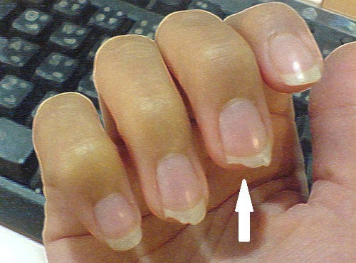 Las uñas  reflejan la salud de los huesos
