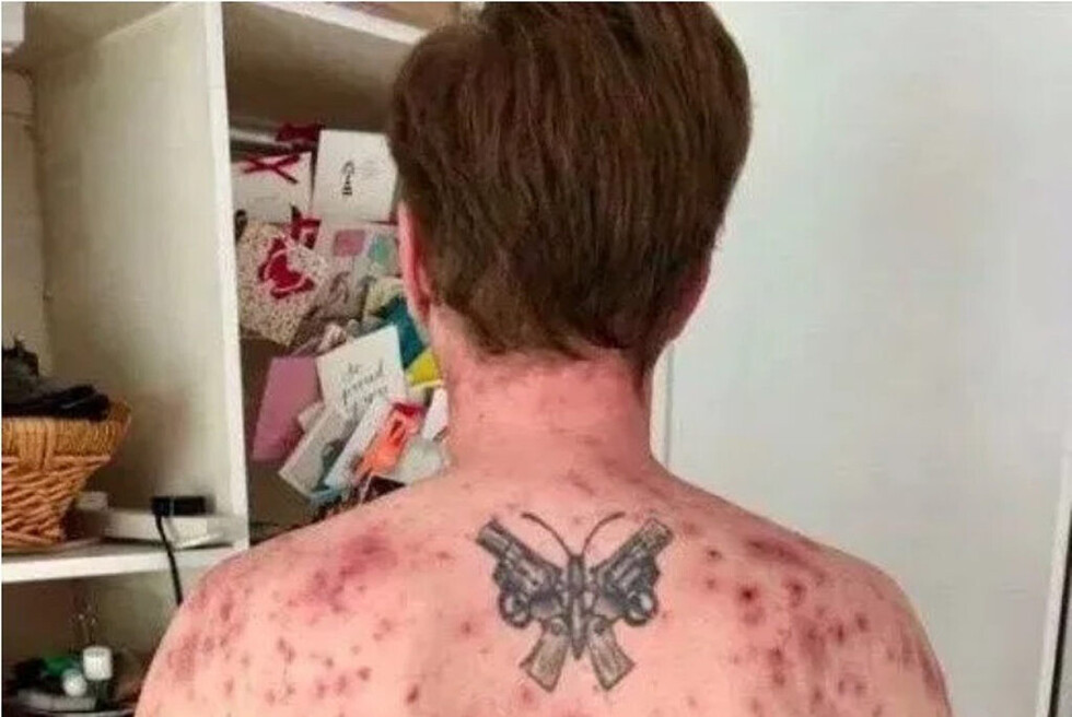 Gusano entró por su pene y casi lo mata
