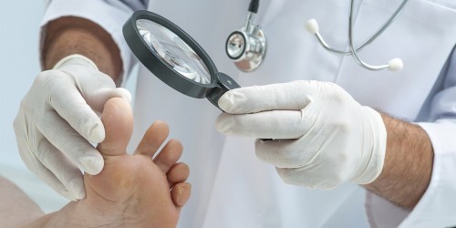 Hongos en las uñas u onicomicosis