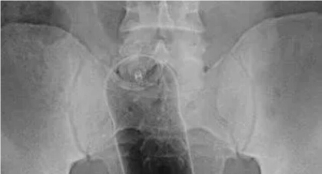 Fue al hospital tras sesión virtual de sexo
