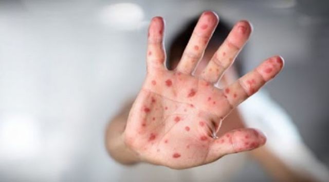 La fiebre amarilla y el sarampión golpea a Brasil