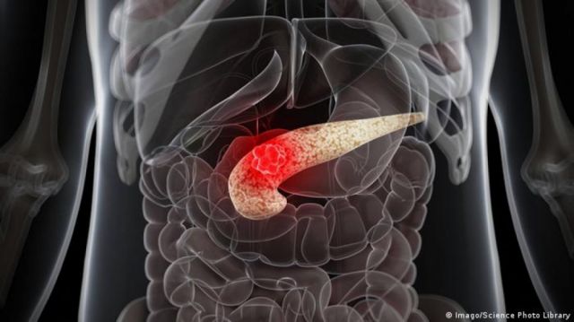 Un virus modificado genéticamente muestra "alentadores" resultados para combatir el cáncer de páncreas
