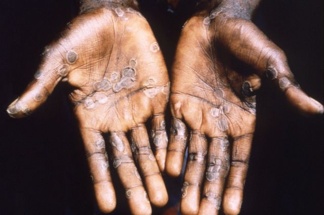 Notifican 780 casos de viruela del mono fuera de África
