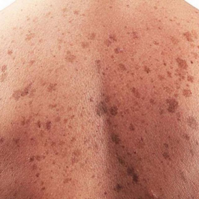 Cáncer de piel el más frecuente en Uruguay