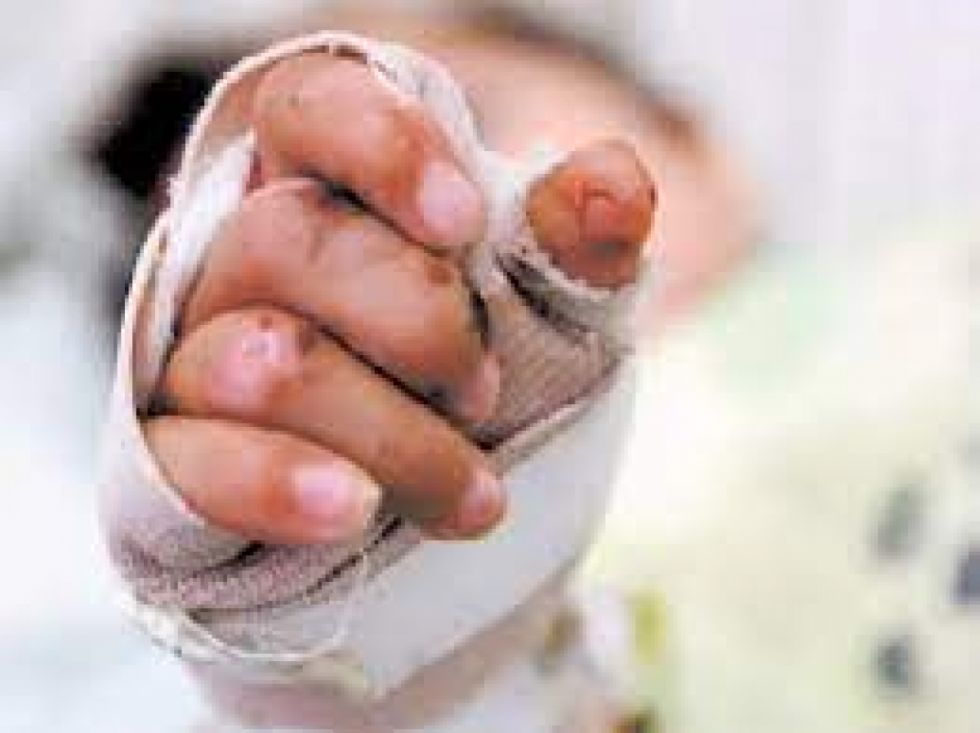Niño de 4 años quemado enfrenta amputaciones de piernas, brazo y oreja izquierda