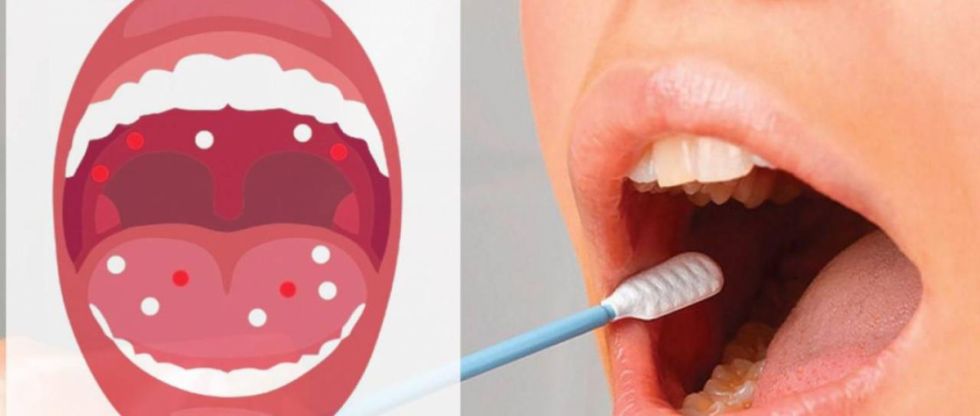 Sedes de Santa Cruz reporta 442 casos de cáncer bucal este año; hay pacientes desde los 18 años