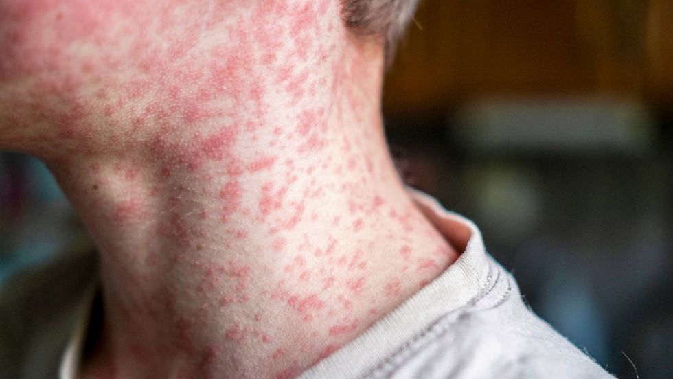 Salud: El sarampión ha regresado a Europa
