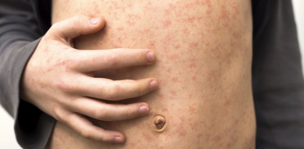 Santa Cruz ya suma 43 casos de sarampión, Salud declara alerta nacional 