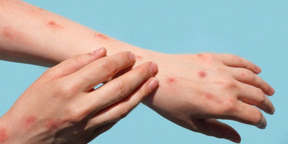 Santa Cruz: Sedes confirma dos casos de viruela del mono y 4 sospechosos 