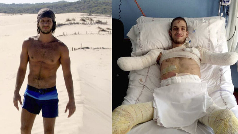 Le amputaron brazos y piernas por error médico