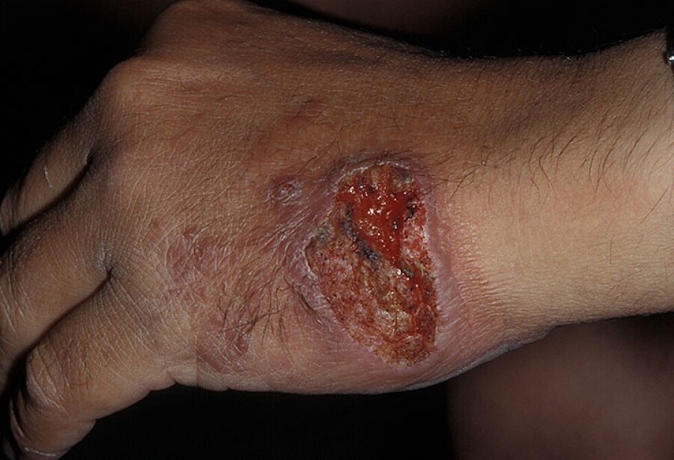 Confirman 60 casos de leishmaniasis en lo que va de año en Tarija